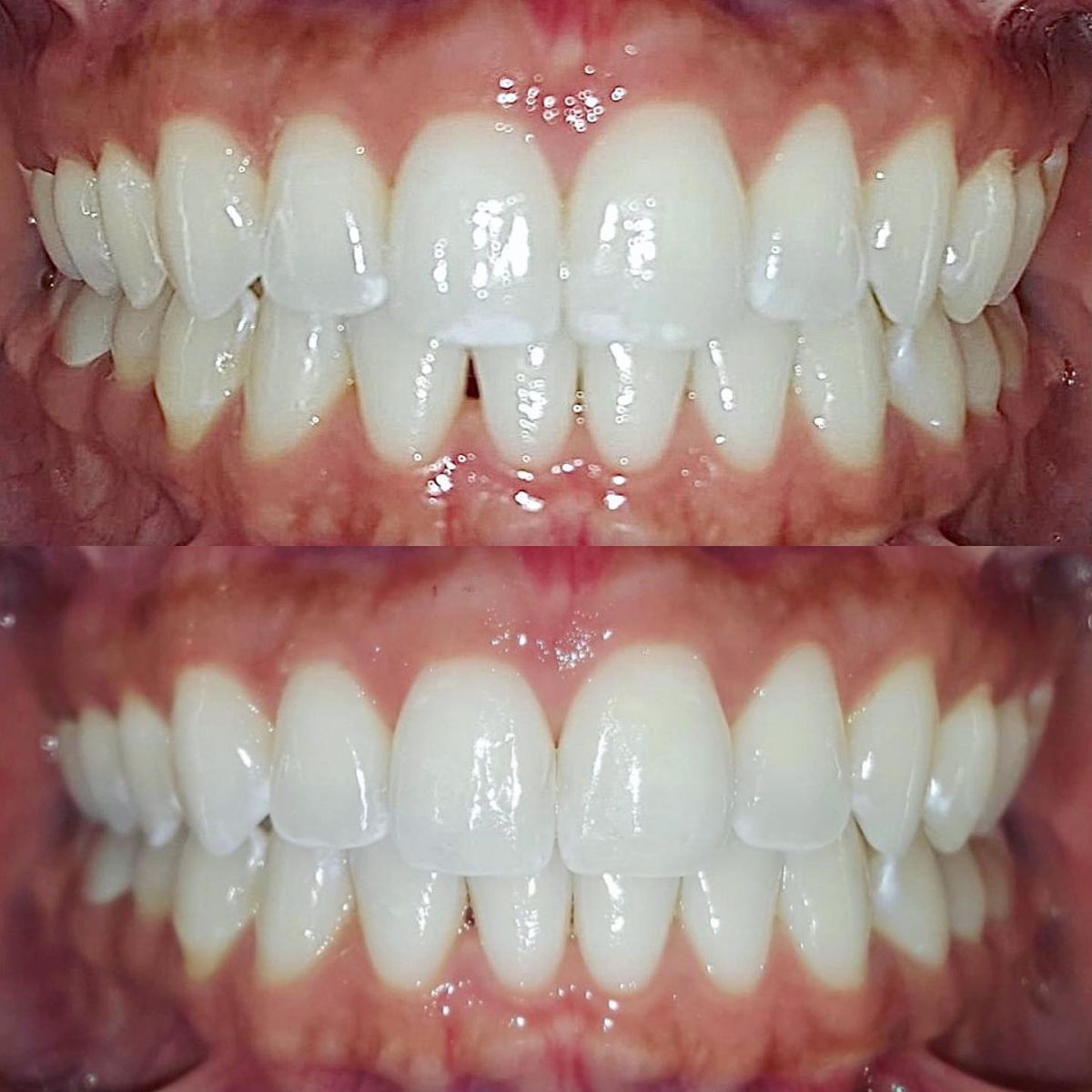 ICON Resin Infiltration Mack & Hansen Orthodontics Longview TX